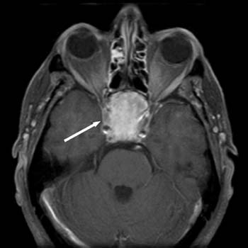 CHORDOMA