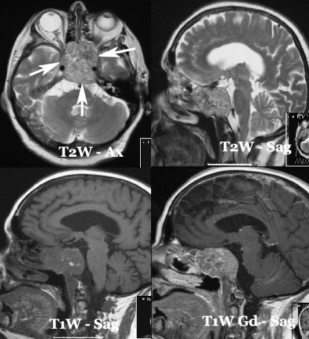 CHORDOMA