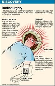 gamma knife